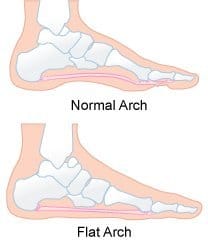 what causes flat feet