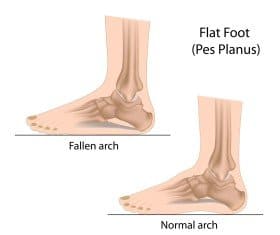 The Most Common Types Of Foot Pain - Product Rankers